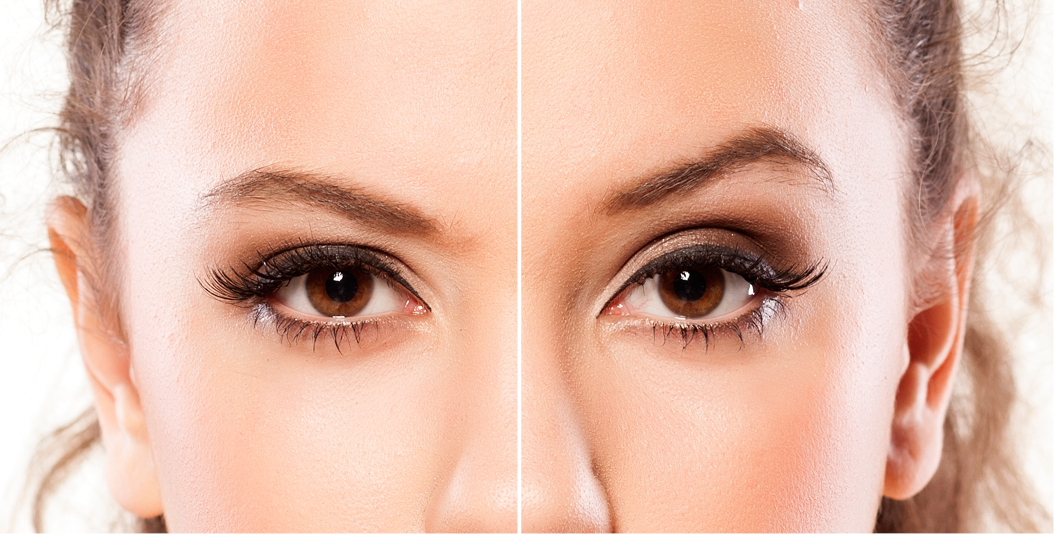 St Clair Cosmetic ClinicBotox Eyebrow Lift Non Surgical Treatment For 